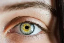 صورة طرق علاج التهاب ملتحمة العين في المنزل بسهولة وفعالية