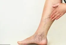 صورة لماذا تظهر الدوالي وكيف يمكن علاجها؟