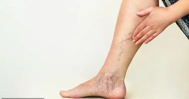 صورة لماذا تظهر الدوالي وكيف يمكن علاجها؟