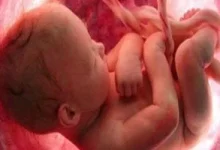 صورة ما هي متلازمة السائل الأمينوسى التي تسبب تشوه الجنين
