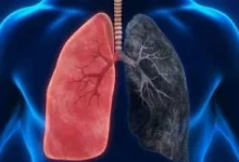 صورة كيف تختلف أعراض سرطان الرئة عند النساء والرجال.. 4 طرق للوقاية