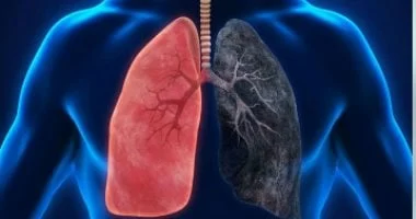صورة كيف تختلف أعراض سرطان الرئة عند النساء والرجال.. 4 طرق للوقاية
