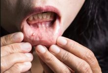 صورة علامات خفية وغير مؤلمة تدل على الإصابة بسرطان الفم