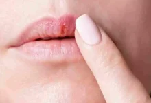 صورة الشفاه مرآة صحتك.. علامات لا تتجاهلها