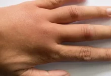 صورة تظهر على أصابعك- 3 علامات تخبرك بأن كبدك مريض.. أعراض أمراض الكبد على