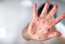 صورة الحصبة في الصدارة.. ما هي أخطر وأكثر الأمراض انتشارا في العالم؟