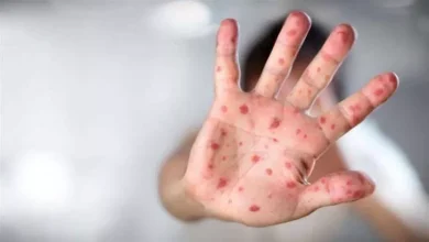 صورة الحصبة في الصدارة.. ما هي أخطر وأكثر الأمراض انتشارا في العالم؟