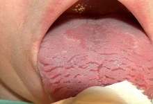 صورة ما أسباب وأعراض وعلاج اللسان الصدفي؟