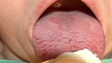 صورة ما أسباب وأعراض وعلاج اللسان الصدفي؟