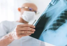 صورة اكتشاف علاج جديد مبتكر لسرطان الرئة بنسبة نجاح تصل إلى 90%