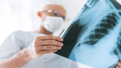 صورة اكتشاف علاج جديد مبتكر لسرطان الرئة بنسبة نجاح تصل إلى 90%