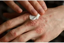 صورة الرجال أكثر عرضة للإصابة بمرض الصدفية وينتشر في العمر أقل من 30 عاما