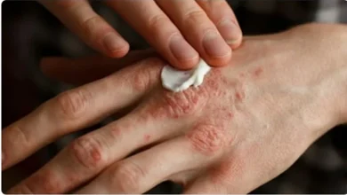 صورة الرجال أكثر عرضة للإصابة بمرض الصدفية وينتشر في العمر أقل من 30 عاما