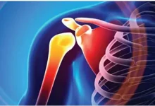 صورة استشاري يوضح مفهوم كسر العظام المضاعف وأسبابه
