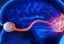 صورة لا يوجد علاج لحالة الاعتلال البصري