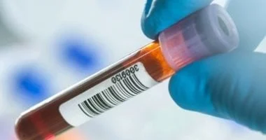 صورة هل الصيام ضروري قبل إجراء تحليل الدهون والكولسترول؟