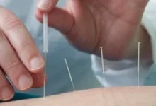 صورة هل يمكن أن يساهم الوخز بالإبر الصينية في التعافي من السكتة الدماغية؟