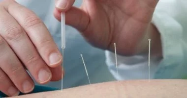 صورة هل يمكن أن يساهم الوخز بالإبر الصينية في التعافي من السكتة الدماغية؟