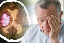 صورة احذر.. 7 علامات تحذيرية ينبهك بها جسمك قبل حدوث السكتة الدماغية