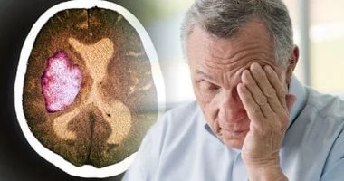 صورة احذر.. 7 علامات تحذيرية ينبهك بها جسمك قبل حدوث السكتة الدماغية
