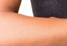 صورة أسباب ظهور الكدمات على الجسم بسهولة