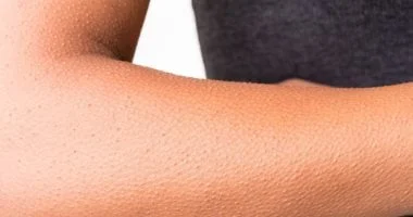 صورة أسباب ظهور الكدمات على الجسم بسهولة