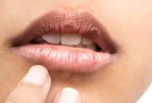 صورة 6 علامات تظهر على الشفتين تدل على مشاكل صحية كامنة