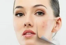 صورة احذر.. فقع البثور في هذه المنطقة من وجهك قد يسبب لك مرضاً خطيراً