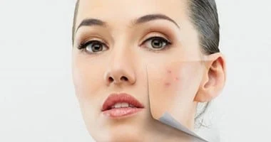 صورة احذر.. فقع البثور في هذه المنطقة من وجهك قد يسبب لك مرضاً خطيراً