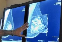 صورة هل يؤدي الإشعاع الناتج عن الفحوصات الطبية إلى زيادة خطر الإصابة بسرطان الثدي؟
