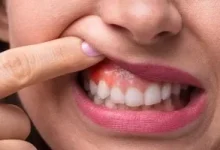 صورة خطوات الفحص الذاتي للكشف المبكر عن سرطان الفم ووسائل الوقاية