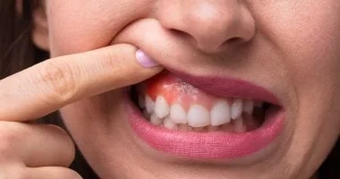 صورة خطوات الفحص الذاتي للكشف المبكر عن سرطان الفم ووسائل الوقاية