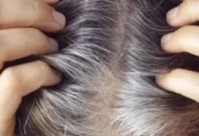 صورة أسباب الشيب المبكر للشعر ومتى يكون مؤشراً على مشكلة فى القلب؟ وطرق العلاج