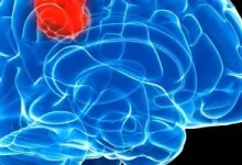 صورة دراسة تكشف سبب مقاومة بعض أورام المخ للعلاج الإشعاعي وتعتمد نهجا علاجيا جديدا