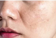صورة لا يقتصر على العظام.. نقص فيتامين د يسبب جفاف البشرة وهذه مصادره الغذائية