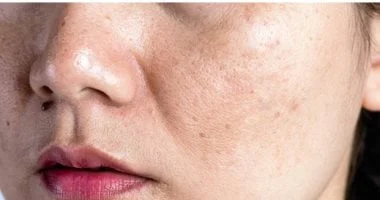 صورة لا يقتصر على العظام.. نقص فيتامين د يسبب جفاف البشرة وهذه مصادره الغذائية