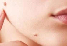 صورة 9 علامات جلدية تدل على مشاكل صحية كامنة