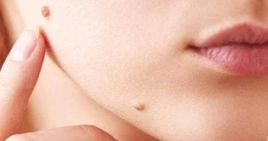 صورة 9 علامات جلدية تدل على مشاكل صحية كامنة