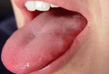 صورة اصفرار اللسان: ما أسبابه ومتى يجب القلق؟