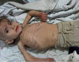 صورة الصحة : 13 حالة وفاة في غزة بسبب المجاعة وسوء التغذية